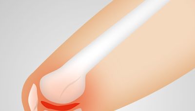 Osteoarthritis may double risk of speedy progression to severe multimorbidity, study finds