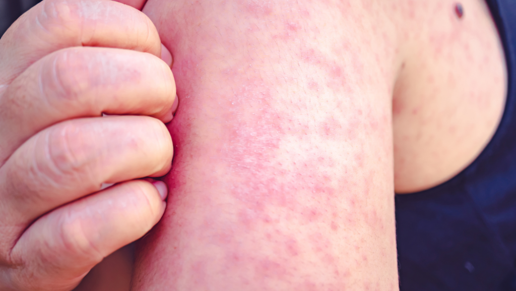 Louisiana’s third measles case this year reported in New Orleans visitor