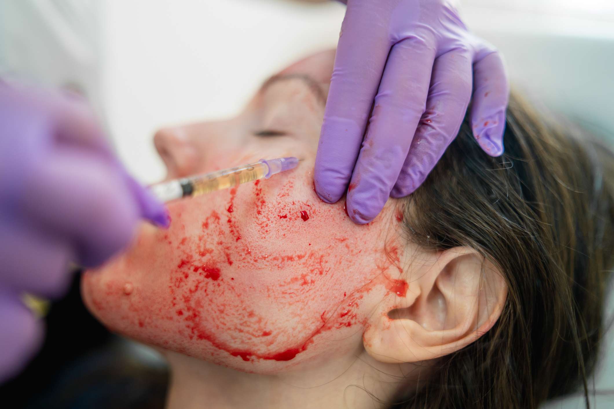 What Is a 'Vampire Facial'? Experts Discuss the Cosmetic Procedure and Risk of HIV Infection