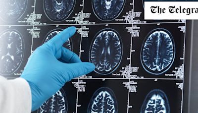 One in 50 people is ‘highly likely’ to develop Alzheimer’s disease