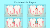 Periodontitis: Early Symptoms and Advanced Gum Disease