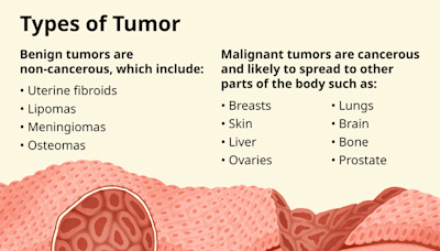 Tumor Defined: The Different Types and How They Form