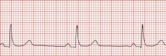 Bradycardia