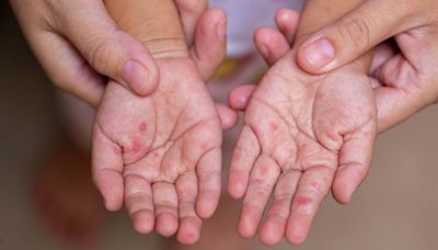 Hand, foot, mouth disease spreads in San Antonio as temps rise