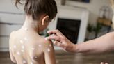 Chickenpox Q&A: what is it, is it dangerous and how can I help my child?