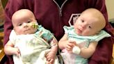 Mother’s heartbreak as twin daughters both diagnosed with rare eye cancer