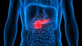 HUTCHMED begins trial of combination therapy for pancreatic ductal adenocarcinoma