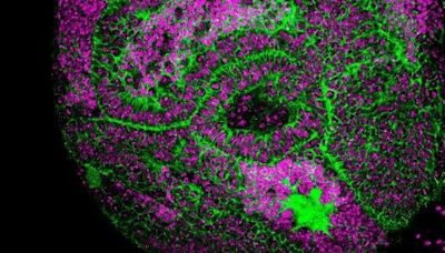 Investigadores de Barcelona descubren dos "genes esenciales" relacionados con la reducción de tumores cerebrales