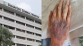 Singapore General Hospital apologises after Facebook user raises unhappiness over father's bruised hands