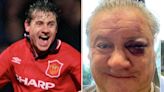 Unrecognisable ex-Man Utd star shows off gruesome black eye after 'bar attack'
