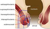 Anal fistula