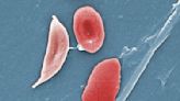 FDA moves closer to sickle cell cure that uses gene editing