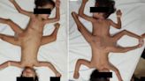 Ultra rare 'spider twins' are born with three legs, four arms and one penis