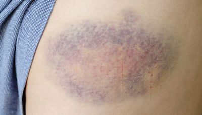 Doctor Shares Red Flag Signs Your Bruise Is Something More Serious
