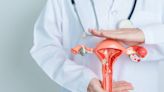 El quiste de ovario: un compañero silencioso que puede detectarse con revisiones