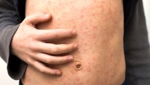 ‘Out-of-town visitor’ tests positive for measles in Cincinnati