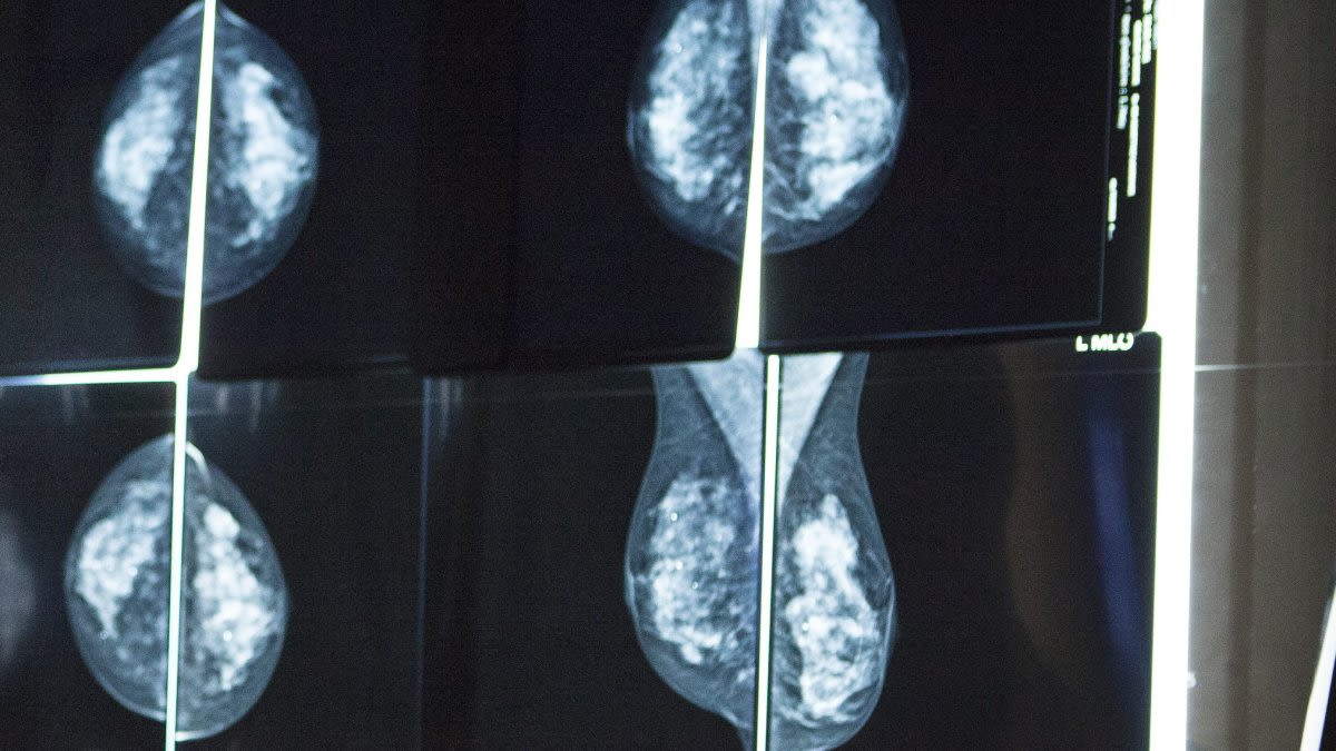 Dense breast patients battle to get coverage for cancer screenings