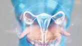 En Perú, el 75% de cáncer de ovario se diagnostica en etapa avanzada