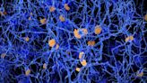 Study reveals how a particular gene can cause Alzheimer's disease