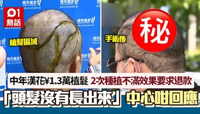 中年漢花¥1.3萬植髮 等足1年「沒長出來」要求退款 中心咁回應