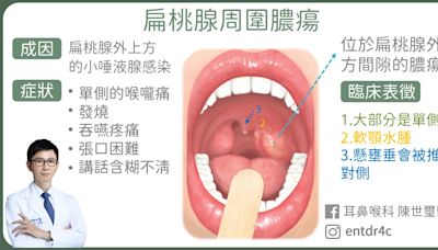 27歲外送員喉嚨痛當感冒！抽出「一管黃膿」 扁桃腺已膿瘍