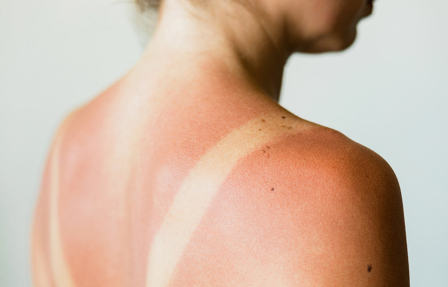 Do you have heat rash or sun poisoning? Look for these important differences, derms say