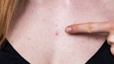 Dealing With Annoying Pimples on Your Chest? Here Are the Top Causes of Chest Acne—and What to Do About It