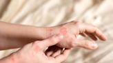 A salty diet may increase eczema in adults, study finds