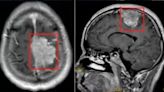 32歲男子腳麻「夾不住人字拖」竟是腦瘤 X光驚見直徑達5.6厘米
