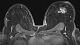 Resonancia magnética (MRI), cuándo se utiliza para explorar los senos