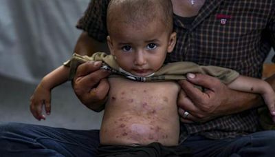 Crisis de enfermedades en la piel en Gaza