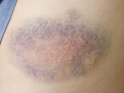 Doctor Shares Red Flag Signs Your Bruise Is Something More Serious