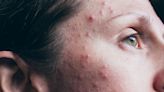 Everything You Need to Know About Acne