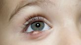 What Parents Should Know About Bumps Under Eyelids