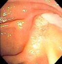 Ascending cholangitis