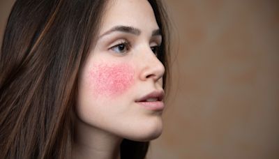 Understanding Rosacea: 10 Natural Ways to Soothe and Calm Red, Irritated Skin