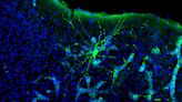 Un nuevo estudio abre camino a la detección precoz de la metástasis cerebral