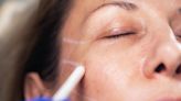 What is a thread lift? The latest trendy cosmetic procedure explained