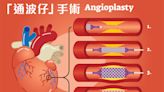 通波仔 | 呼吸急速、胸口壓著可能是冠心病症狀！認識通波仔手術原理、過程、風險及復發機會