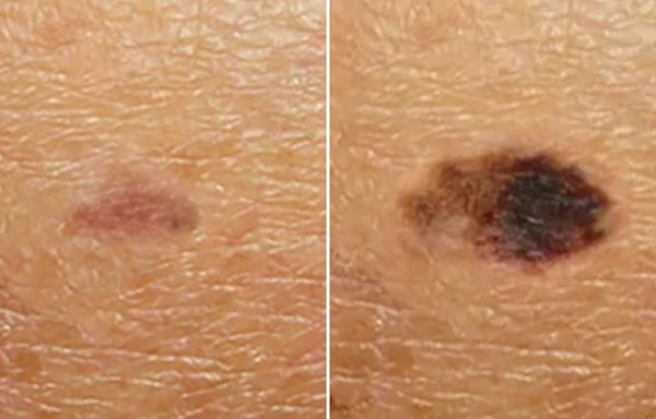 Alarming time-lapse video reveals how tiny 'dark patch' morphs into melanoma