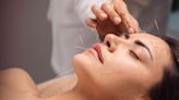Everything You Need to Know About Facial Acupuncture