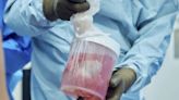 Trasplante de riñón de cerdo funciona en un cuerpo humano desde hace 32 días