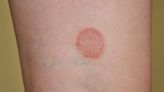 1st case of hard to kill sexually-transmitted ringworm reported in US