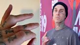 Travis Barker Gets Ready for Surgery and Shares Graphic Photos of His Injured Ring Finger