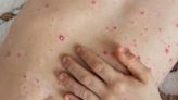 Warning over 'painful' infection caused by virus - first signs to watch out for