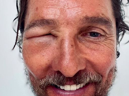Matthew McConaughey shows off brutal bee sting