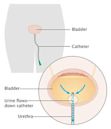 Complication (medicine)