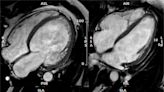 Study provides first stratification of the risk of developing dilated cardiomyopathy in symptom-free genetic carriers