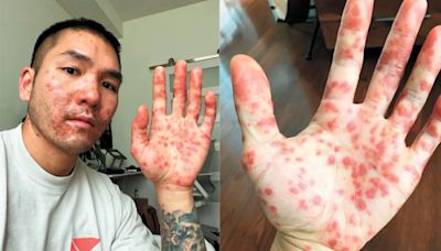 美華裔男患猴痘被多次誤診 致病情惡化險盲