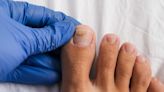 ¿Cómo eliminar los hongos de las uñas de los pies?